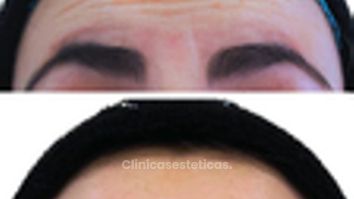 Toxina Botulínica - Doctora Alexandra Mora