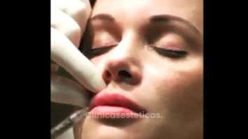 Aumento de labios con ácido hialurónico