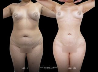 Liposucción - Dr. Luis Fernando Reyes