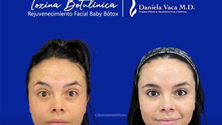 baby botox antes y después