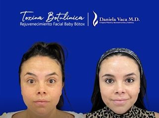 baby botox antes y después