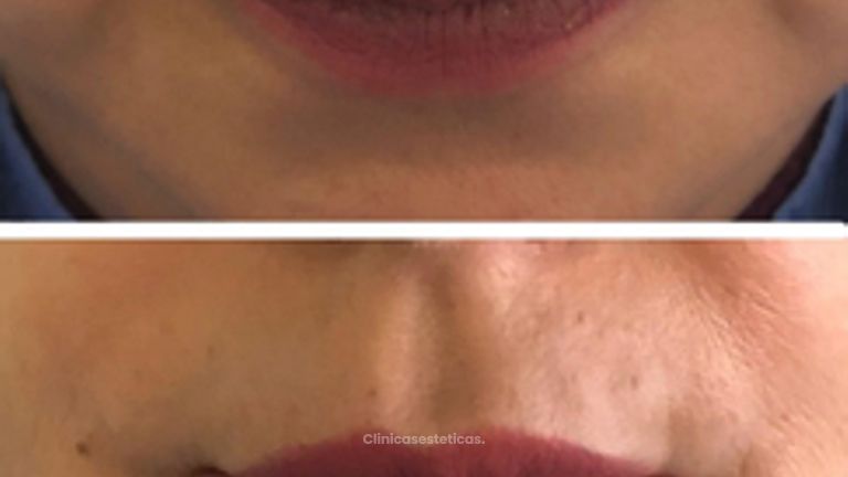 Perfilación de labios - Doctora Alexandra Mora