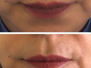 Perfilación de labios - Doctora Alexandra Mora