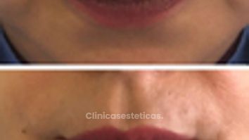 Perfilación de labios - Doctora Alexandra Mora