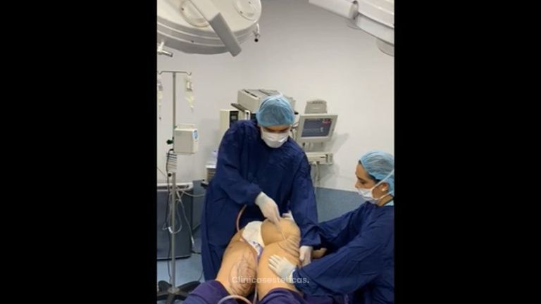 Lipoescultura