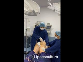 Lipoescultura
