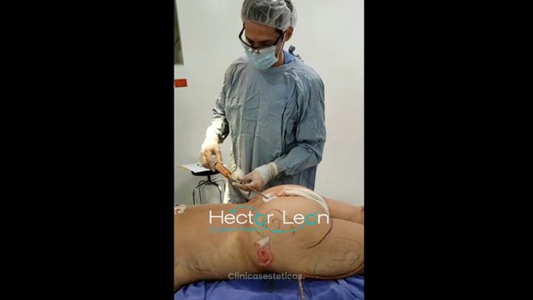 Gluteoplastia