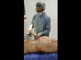 Gluteoplastia