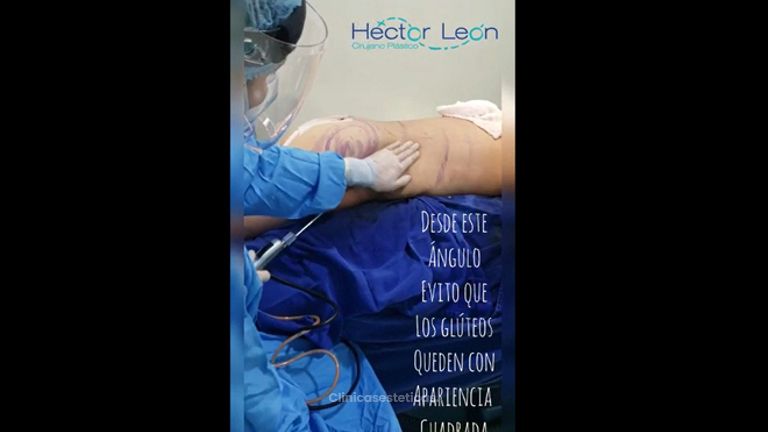 Liposucción - Dr. Héctor Guillermo León Higuera