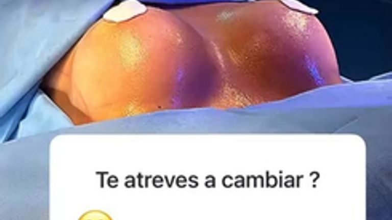 Mamoplastia en Aumento - Clinica Vivir