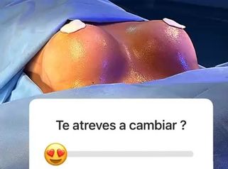 Mamoplastia en Aumento - Clinica Vivir