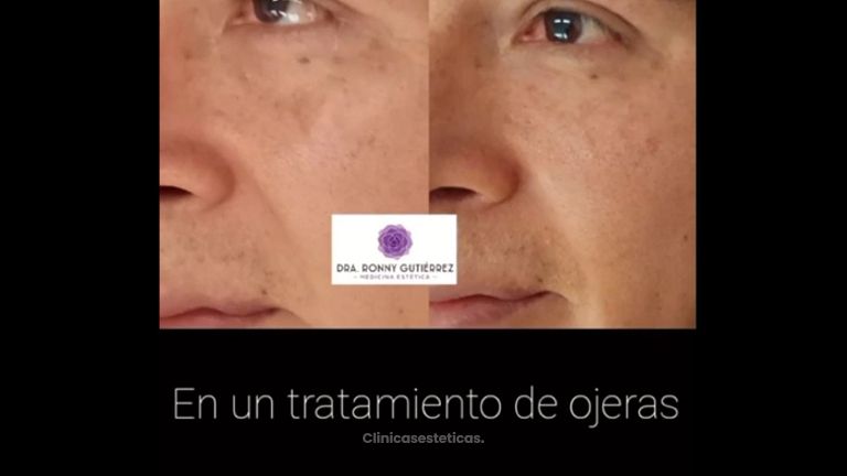Eliminación de las ojeras - Dra. Ronny Gutiérrez